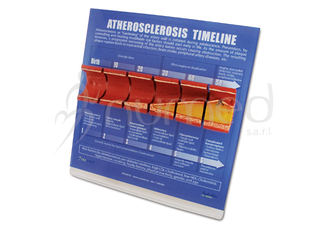 Atherosclerosis Timeline Display (English)