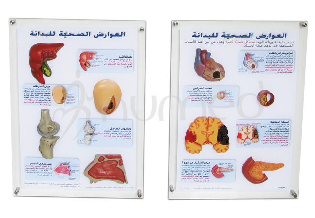Health Risks of Obesity 3D-display (Arabic)