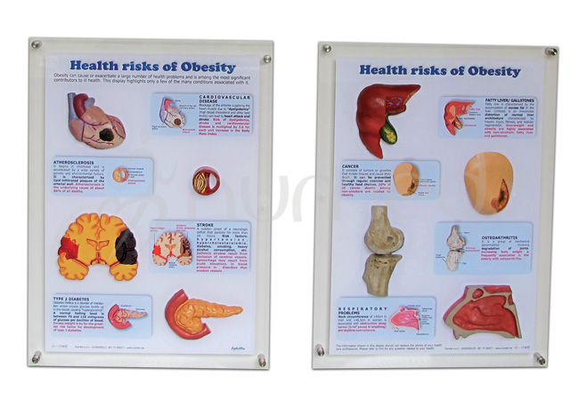 Health Risks of Obesity 3D-display (English)