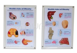 [EOD002E] Health Risks of Obesity 3D-display (English)